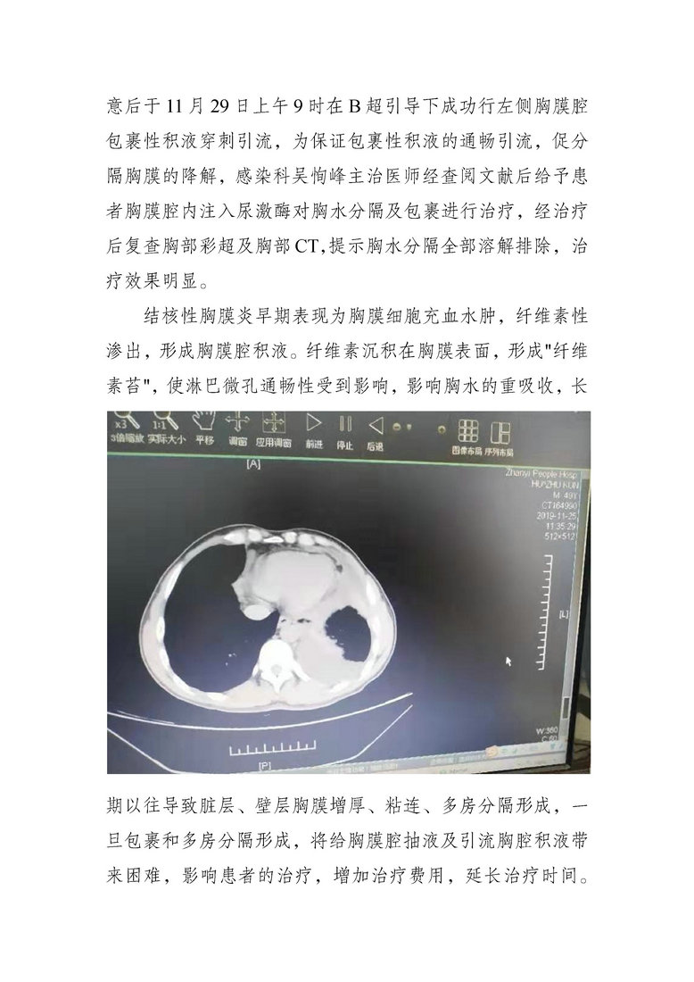 jsj-沾益区人民医院感染性疾病科应用尿激酶胸腔注射灌洗治疗首例多分隔结核性胸膜腔包裹性积液成功(2).jpg